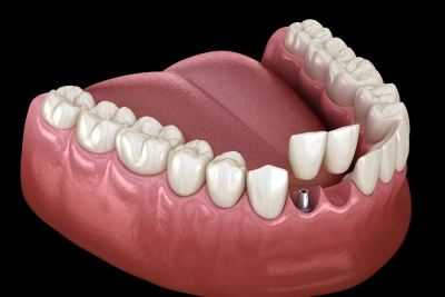 dental implants replacement in joplin