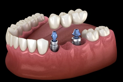 dental implants replacement in joplin