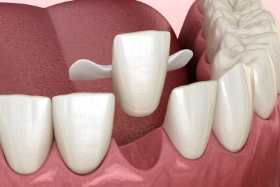 dental implants replacement in joplin