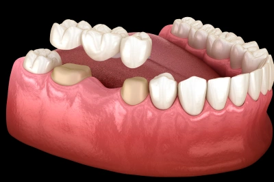 dental implants replacement in joplin